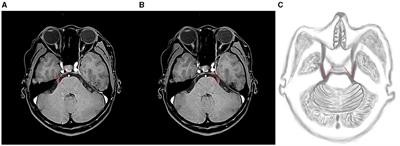 Analyzing the risk factors of unilateral trigeminal neuralgia under neurovascular compression